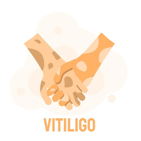 Support Raven's Vitiligo Journey